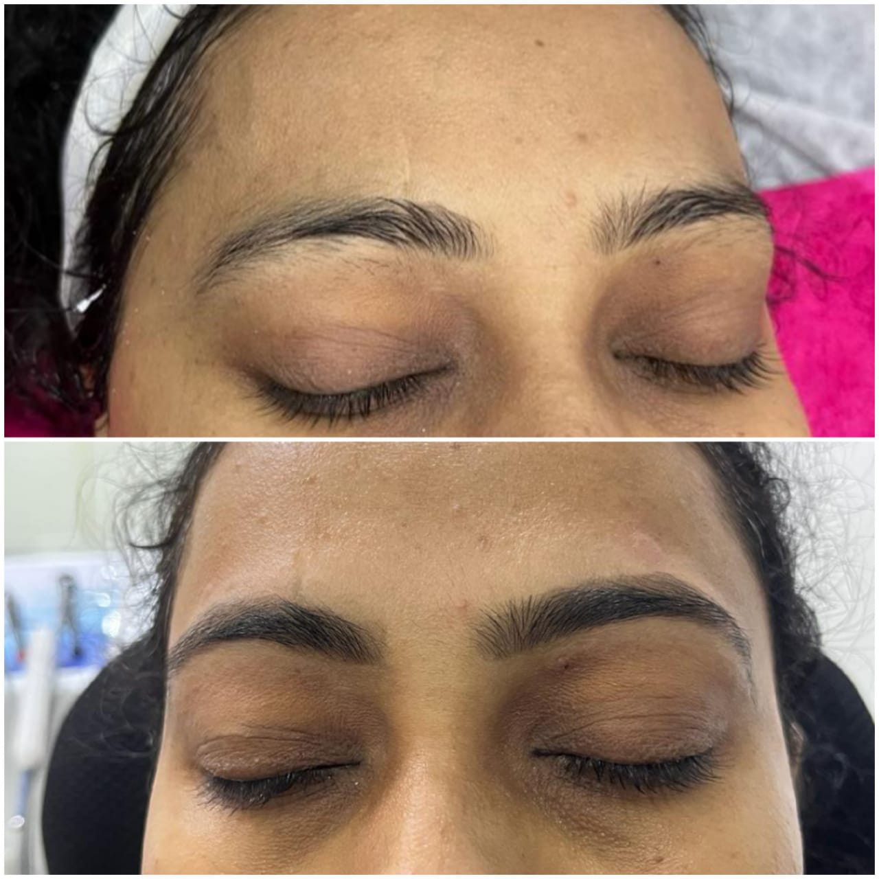 Nano Needling