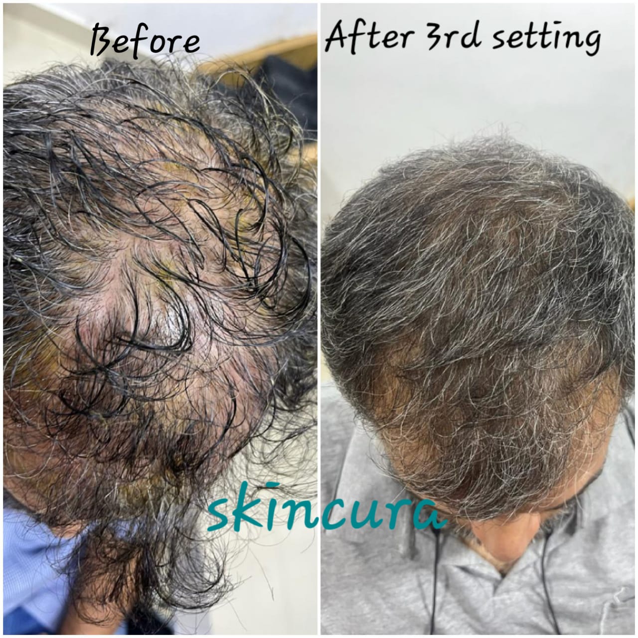 Hair Treatment