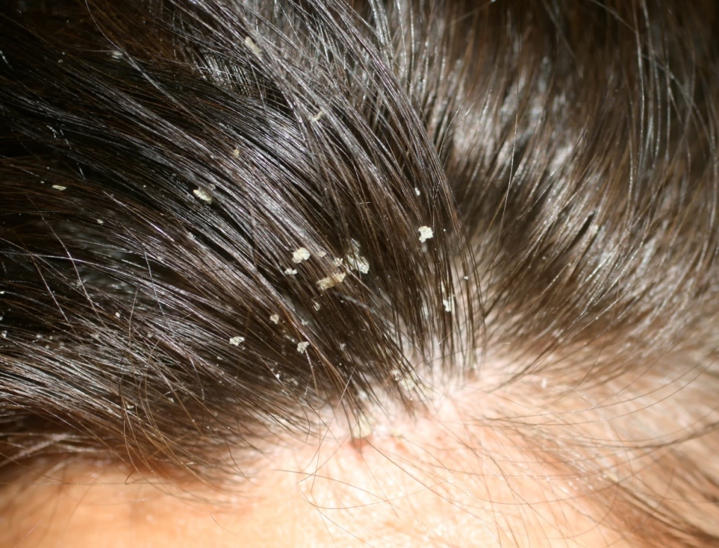 Hair Treatment
