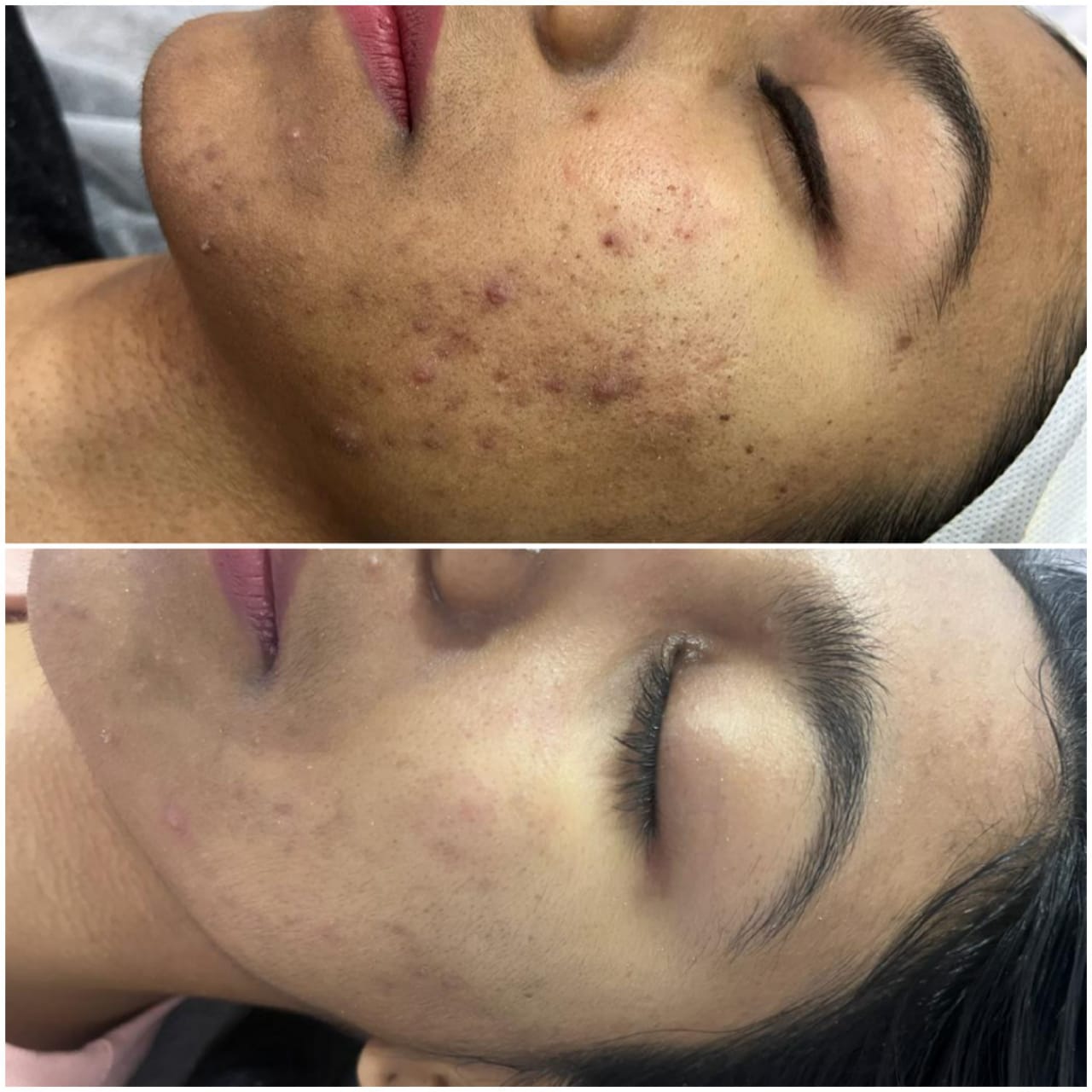 Skin Treatment