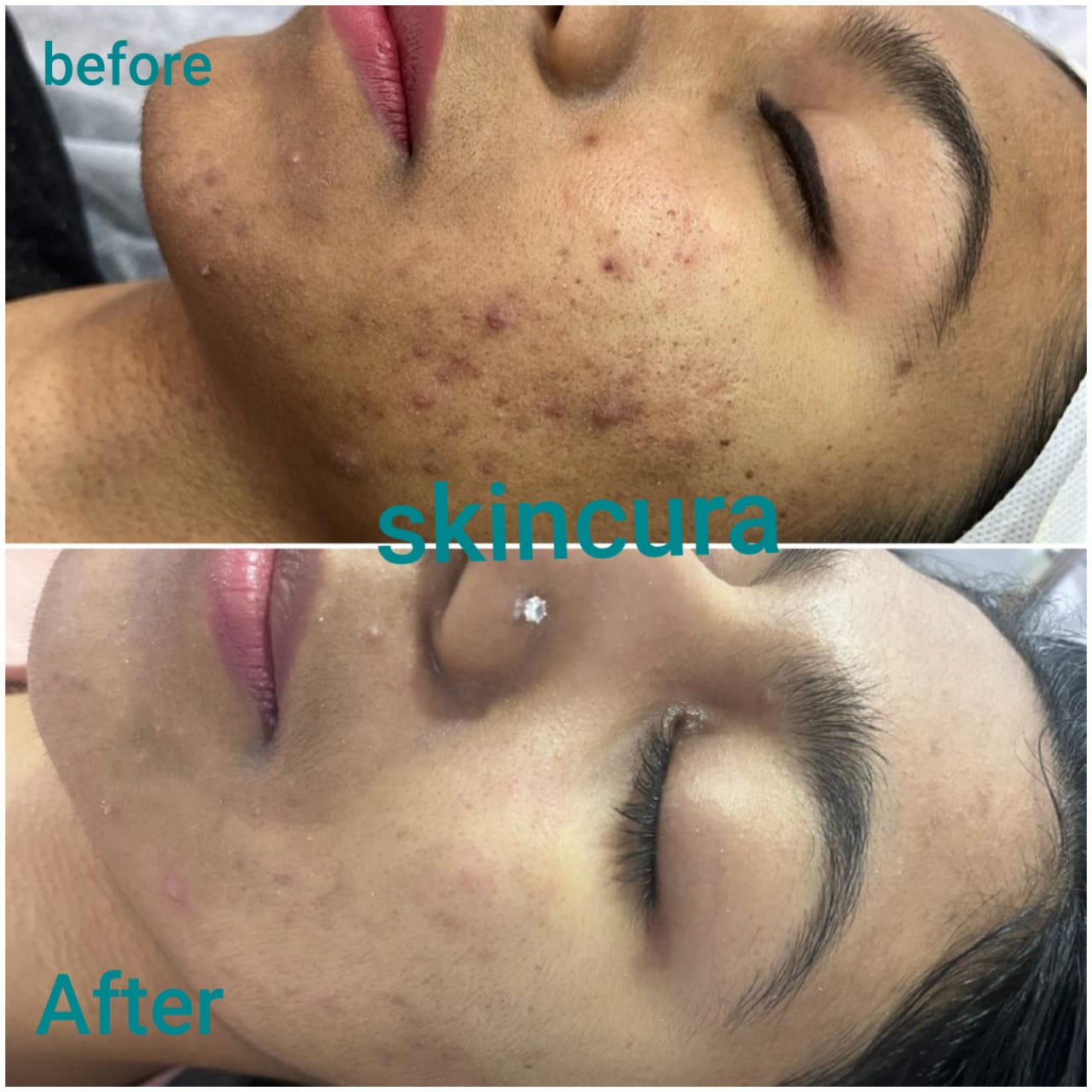 Hydrafacial