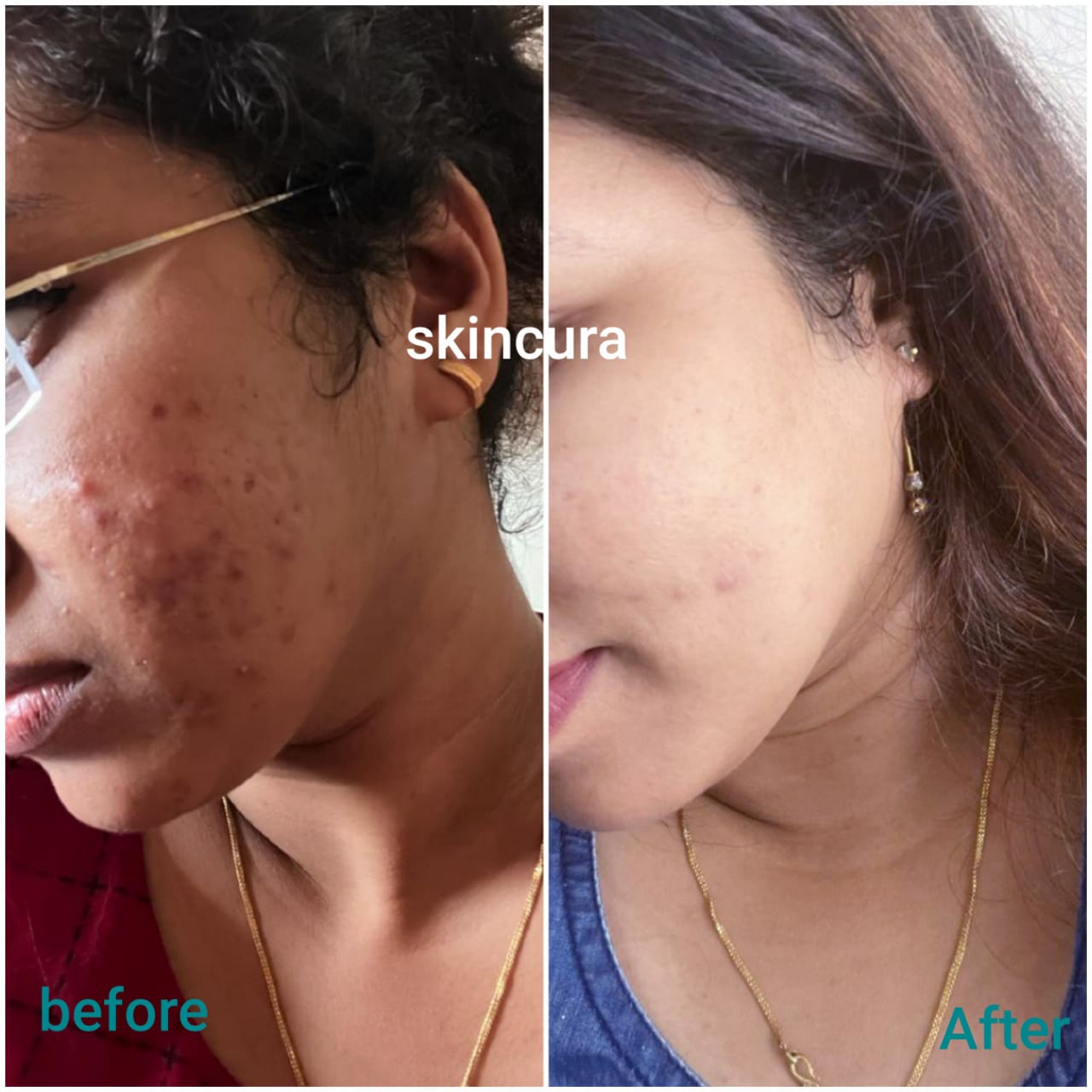 Skin Rejuvenation