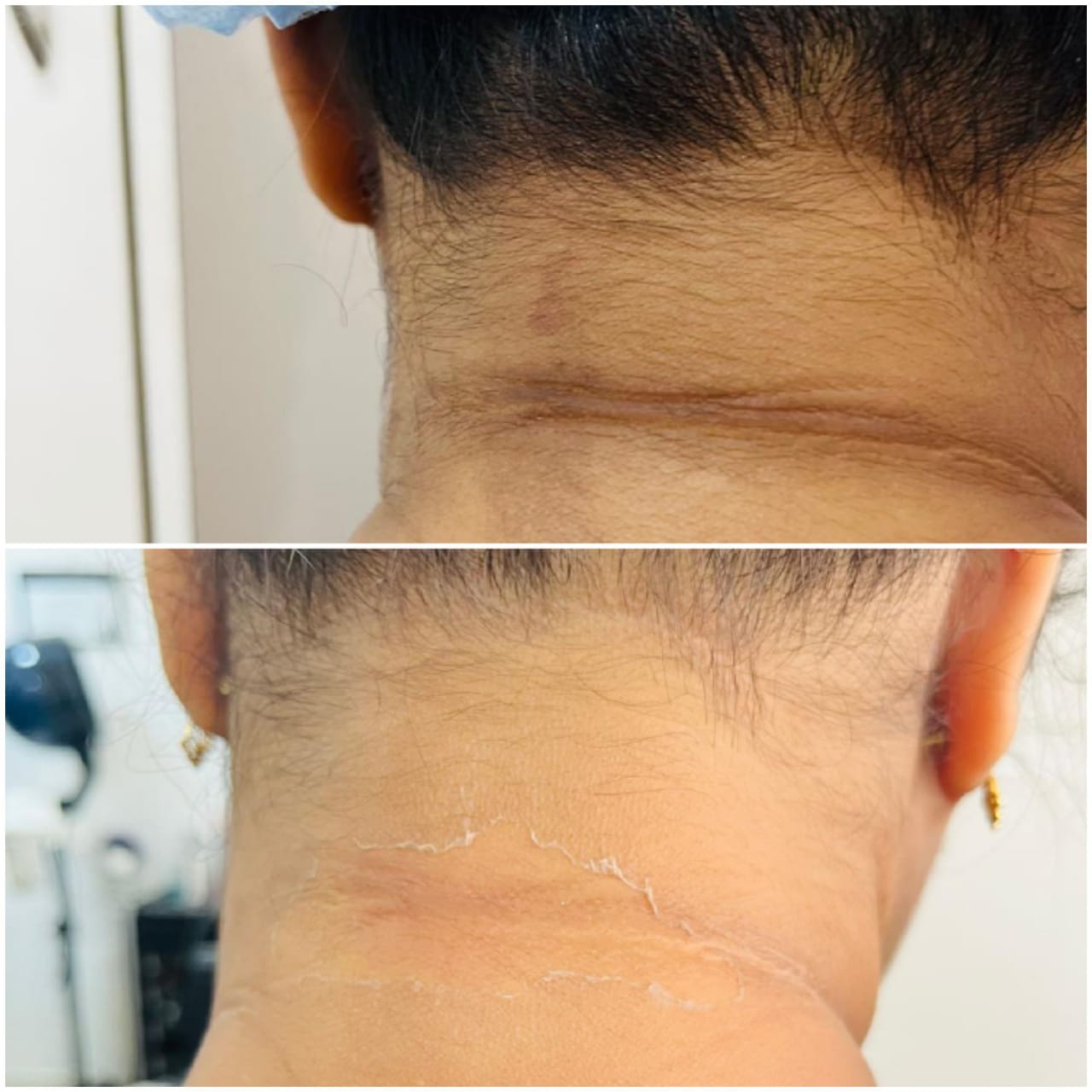Whitening Treatment